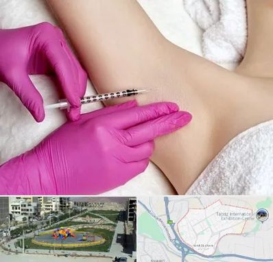 تزریق بوتاکس زیر بغل در مرزداران تبریز