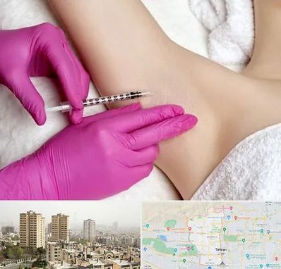 تزریق بوتاکس زیر بغل در منطقه 5 تهران 