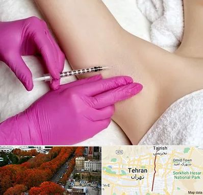 تزریق بوتاکس زیر بغل در ولیعصر 