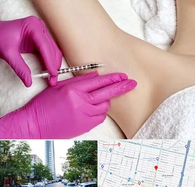 تزریق بوتاکس زیر بغل در امامت مشهد