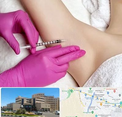 تزریق بوتاکس زیر بغل در صیاد شیرازی مشهد