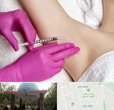 تزریق بوتاکس زیر بغل در کیانشهر