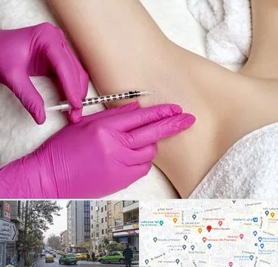 تزریق بوتاکس زیر بغل در فاطمی 