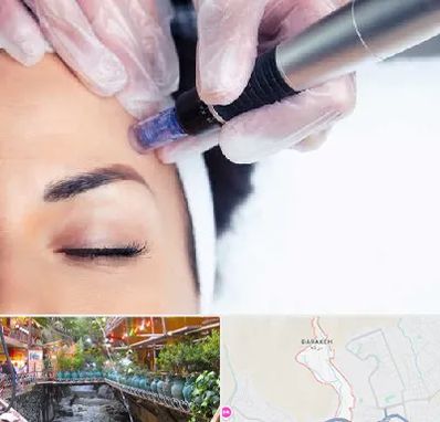 کلینیک مزوتراپی صورت در درکه