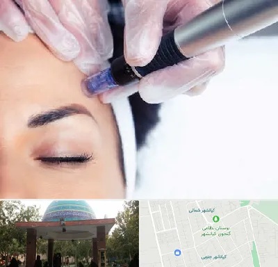 کلینیک مزوتراپی صورت در کیانشهر