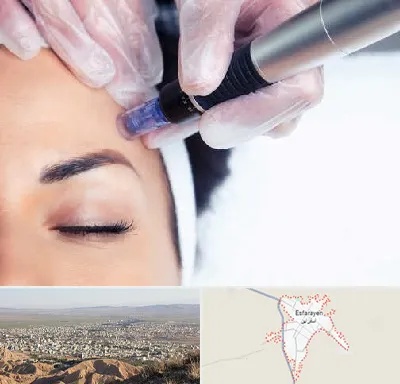 کلینیک مزوتراپی صورت در اسفراین