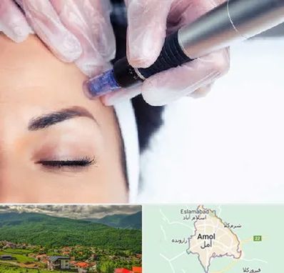 کلینیک مزوتراپی صورت در آمل