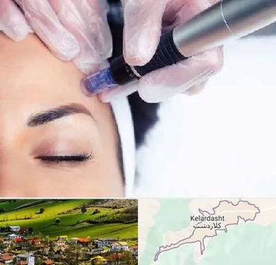 کلینیک مزوتراپی صورت در کلاردشت