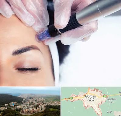 کلینیک مزوتراپی صورت در گرگان