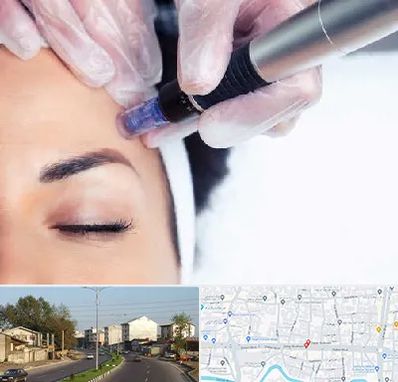 کلینیک مزوتراپی صورت در ضیابری رشت