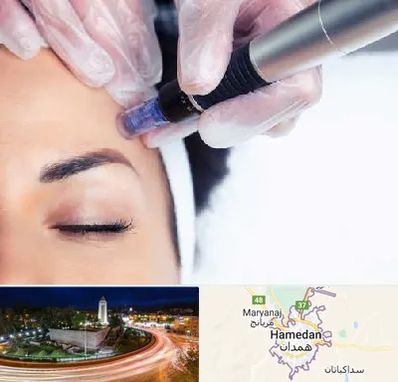 کلینیک مزوتراپی صورت در همدان