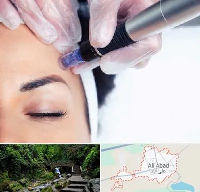 کلینیک مزوتراپی صورت در علی آباد کتول