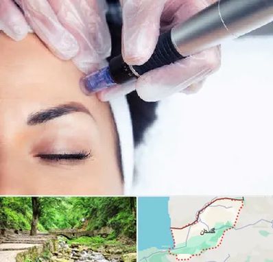 کلینیک مزوتراپی صورت در گلستان