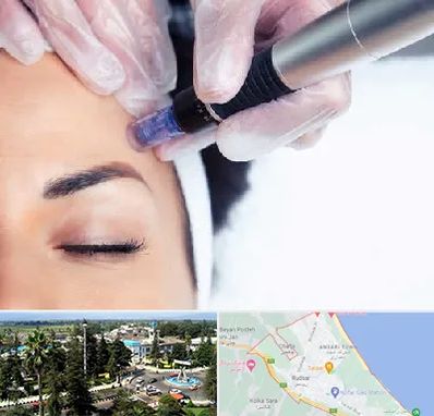 کلینیک مزوتراپی صورت در رودسر