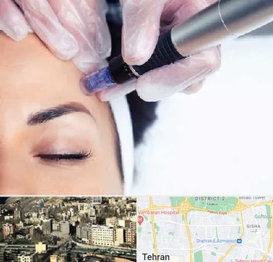 کلینیک مزوتراپی صورت در مرزداران 