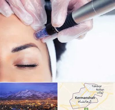 کلینیک مزوتراپی صورت در کرمانشاه