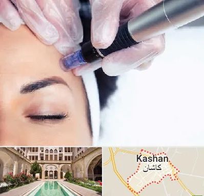 کلینیک مزوتراپی صورت در کاشان