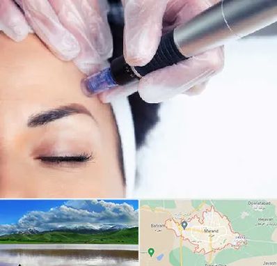 کلینیک مزوتراپی صورت در مرند