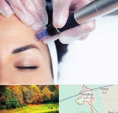 کلینیک مزوتراپی صورت در کردکوی
