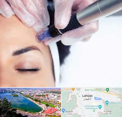 کلینیک مزوتراپی صورت در لاهیجان