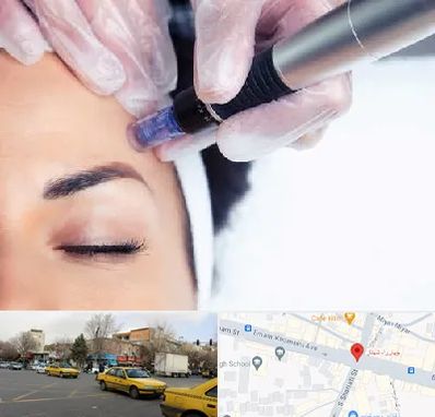 کلینیک مزوتراپی صورت در شهناز تبریز