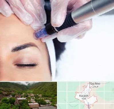 کلینیک مزوتراپی صورت در کلاله
