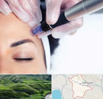 کلینیک مزوتراپی صورت در گچساران
