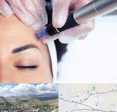 کلینیک مزوتراپی صورت در رودهن