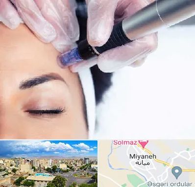 کلینیک مزوتراپی صورت در میانه