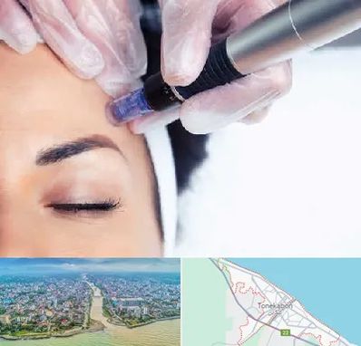 کلینیک مزوتراپی صورت در تنکابن