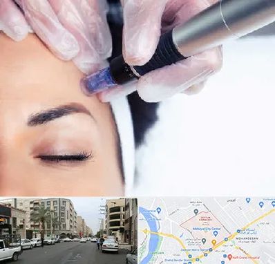 کلینیک مزوتراپی صورت در زیتون کارمندی اهواز