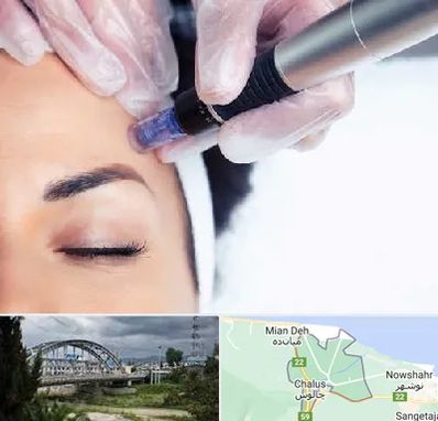 کلینیک مزوتراپی صورت در چالوس