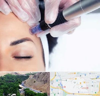 کلینیک مزوتراپی صورت در کن 