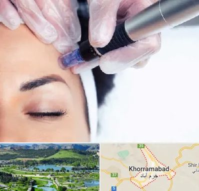 کلینیک مزوتراپی صورت در خرم آباد