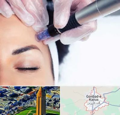 کلینیک مزوتراپی صورت در گنبد کاووس