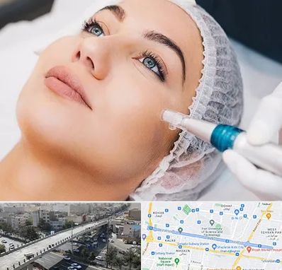 مزونیدلینگ در فرجام