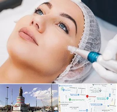 مزونیدلینگ در کارگر جنوبی 