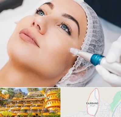 مزونیدلینگ در دربند