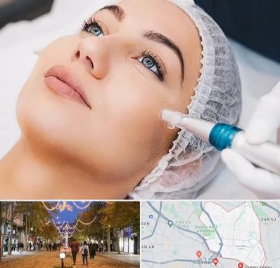 مزونیدلینگ در ولیعصر ارومیه