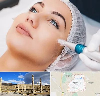 مزونیدلینگ در مرودشت