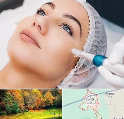مزونیدلینگ در کردکوی