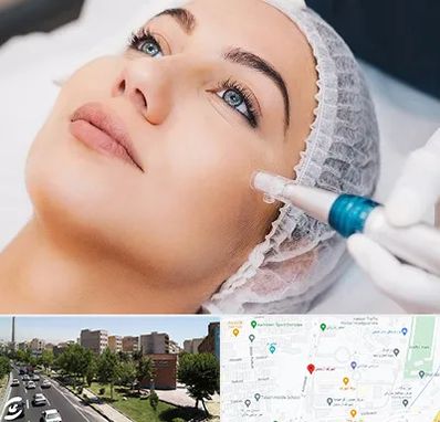 مزونیدلینگ در شهرک آزمایش 