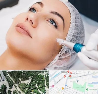 مزونیدلینگ در سالاریه قم