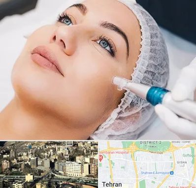 مزونیدلینگ در مرزداران 