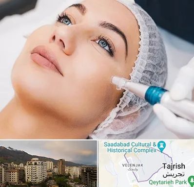 مزونیدلینگ در زعفرانیه 