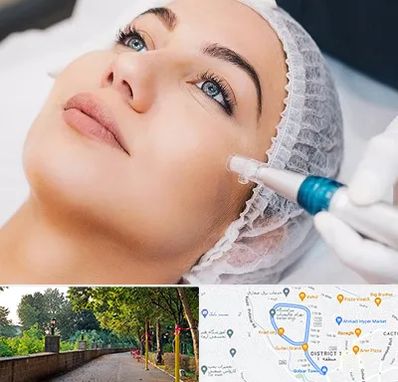 مزونیدلینگ در فلکه گاز رشت