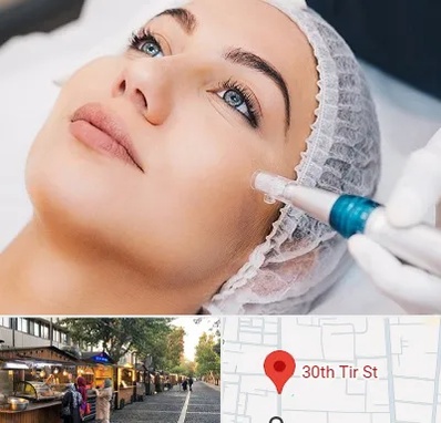 مزونیدلینگ در سی تیر