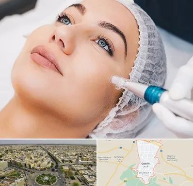 مزونیدلینگ در قزوین