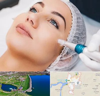 مزونیدلینگ در مهاباد