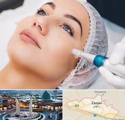 مزونیدلینگ در زنجان